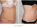 Przed i po zabiegu liposukcji laserowej. Widoczna znacząca redukcja tkanki tłuszczowej i wymodelowanie sylwetki.