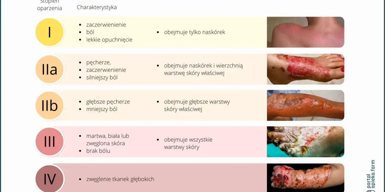 Stopnie oparzeń: I (zaczerwienienie, ból), IIa (pęcherze, silniejszy ból), IIb (głębsze pęcherze), III (martwa skóra, brak bólu), IV (zwęglenie). Leczenie oparzeń, np. maścią argosulfan, zależy od głębokości.