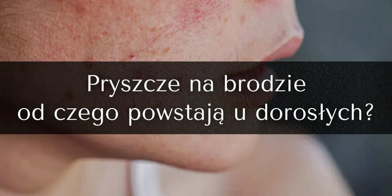 Pryszcze na brodzie: Jak się ich pozbyć? Kompletny poradnik ekspertki