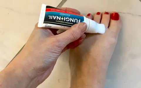 Dłoń aplikuje maść Fungi Nail na paznokcie u stóp. Preparat, podobny do żelu, zawiera metronidazol, pomagając w walce z grzybicą.