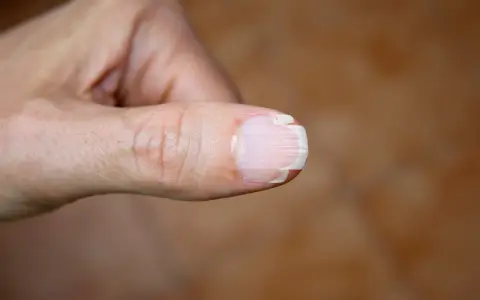 Widoczny kciuk z problemem rozdwajania paznokci. Warstwy paznokcia są oddzielone, tworząc nieestetyczny wygląd.