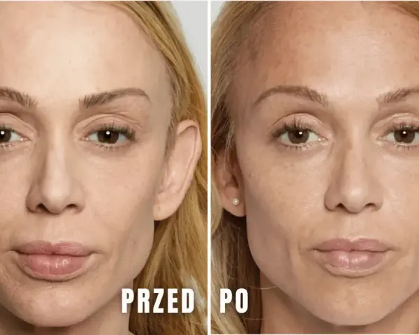 Przed i po zabiegu stymulatorami tkankowymi. Zmniejszenie widoczności zmarszczek i poprawa napięcia skóry. Bez powikłań.
