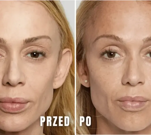Przed i po zabiegu stymulatorami tkankowymi. Zmniejszenie widoczności zmarszczek i poprawa napięcia skóry. Bez powikłań.