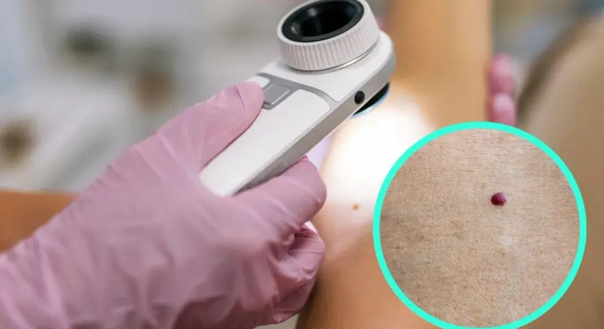 Dermatolog bada punkty rubinowe na skórze. Czerwone kropki na ciele mogą być powodem do niepokoju, ale często są niegroźne.