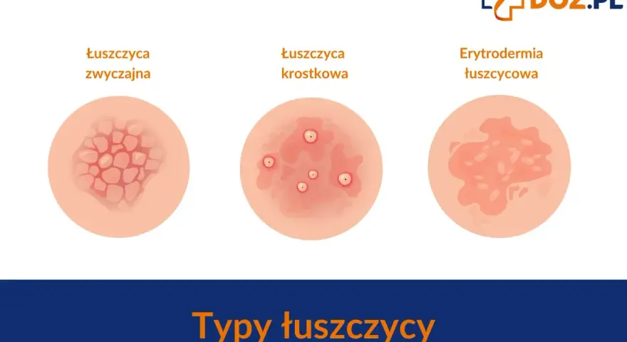 Ilustracja pokazuje trzy typy łuszczycy: zwyczajną, krostkową i erytrodermię łuszczycową.