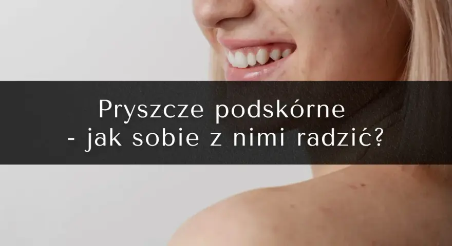 Uśmiechnięta twarz z piegami i pryszczami. Na ramionach widoczne są kolejne zmiany skórne. Tekst: "Pryszcze podskórne - jak sobie z nimi radzić?".