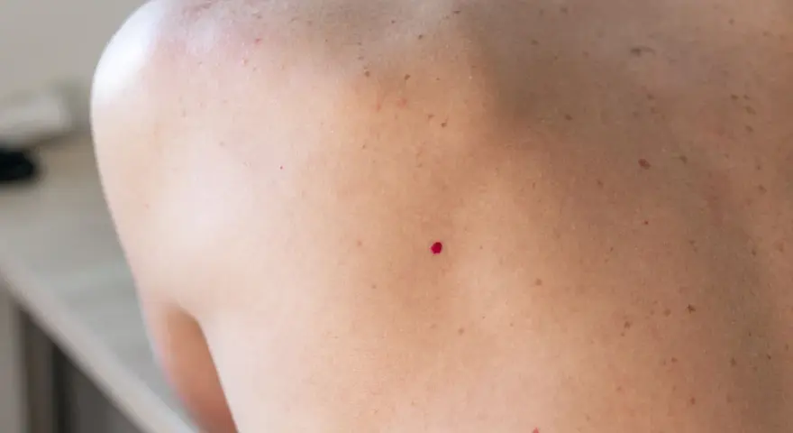 Zbliżenie na skórę pleców z widocznym naczyniakiem rubinowym.