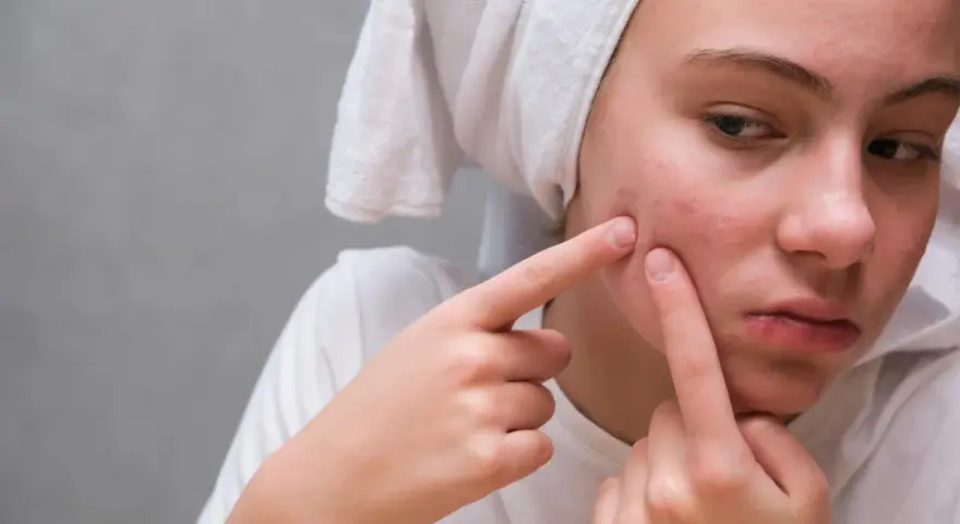 Ropny pryszcz: Jak szybko i skutecznie się go pozbyć? Poradnik