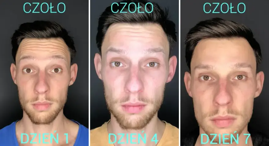 Trzy zdjęcia mężczyzny pokazujące efekt botoksu na czoło: dzień 1 (zmarszczki), dzień 4 (zmniejszone zmarszczki), dzień 7 (gładkie czoło).