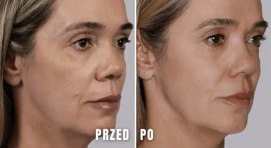 Przed i po zabiegu z użyciem kwasu polimlekowego. Skóra twarzy wygładzona, zmarszczki zredukowane, a owal twarzy poprawiony.