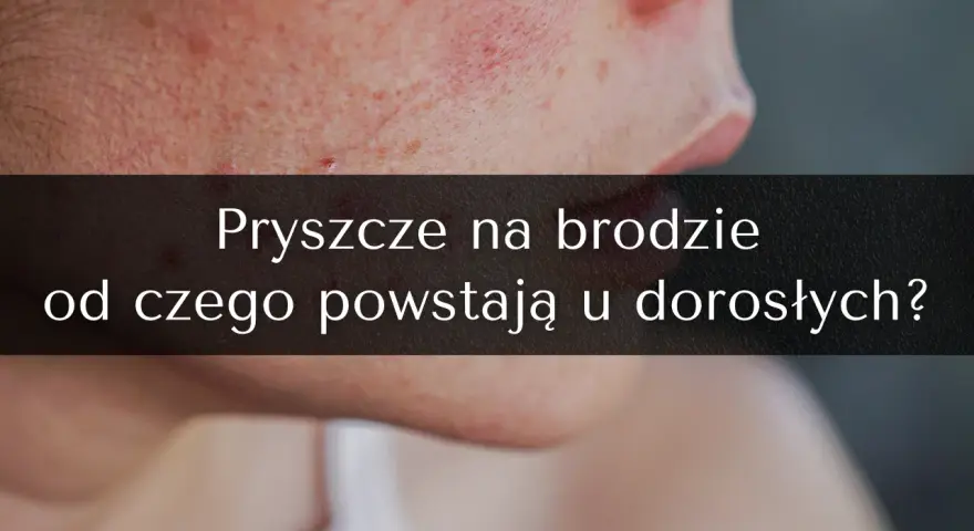 Pryszcze na brodzie: Jak się ich pozbyć? Kompletny poradnik ekspertki