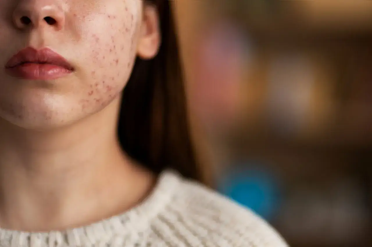 dermatolog leczenie trądziku