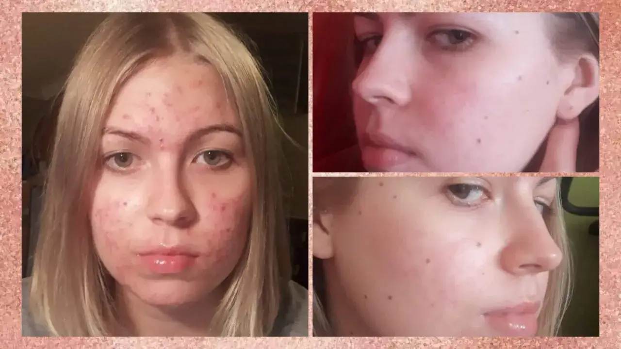Przed i po kuracji lekiem Curacne 20 mg. Widoczna poprawa stanu cery, zmniejszenie zmian trądzikowych.