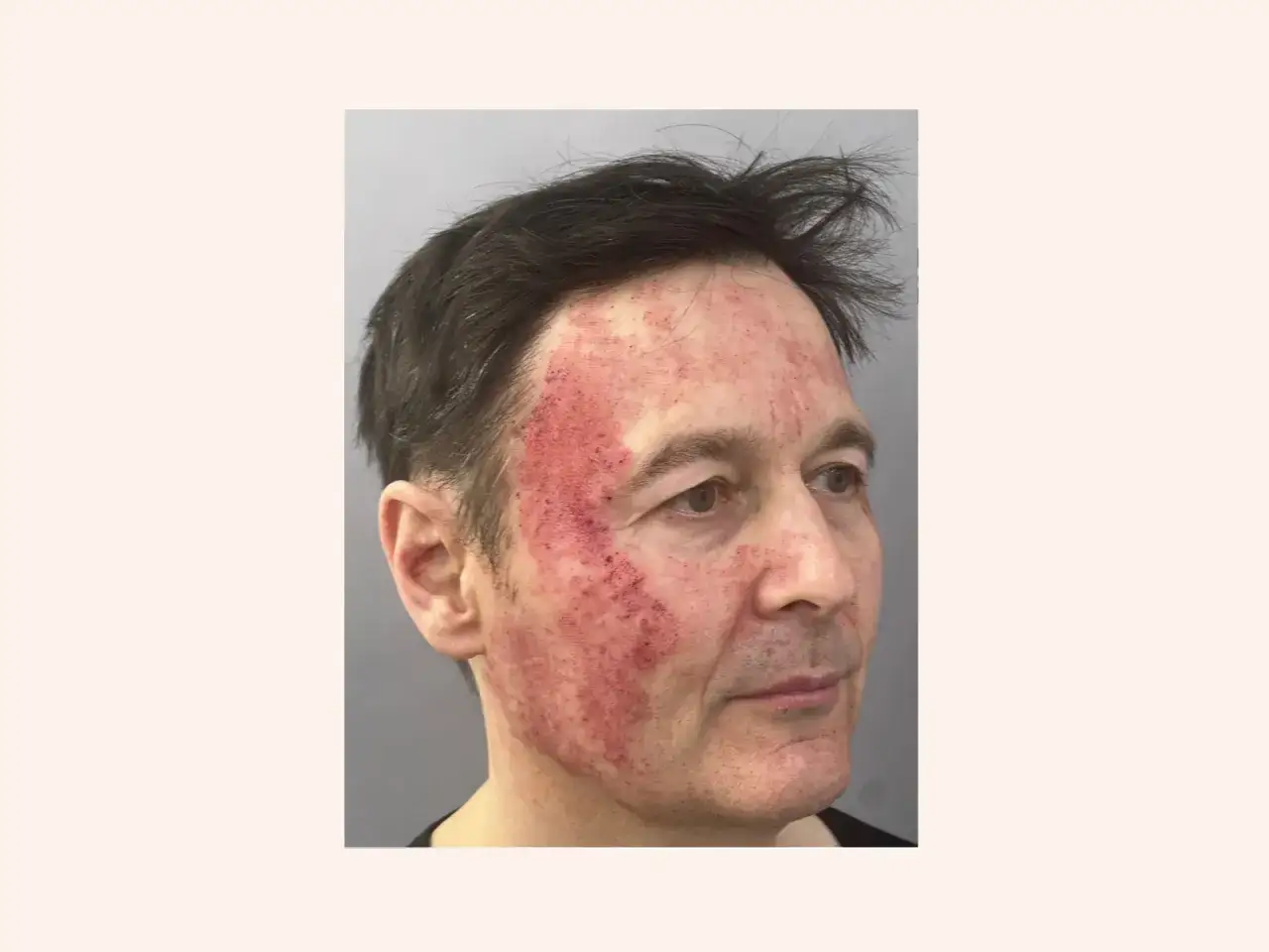 Skóra mężczyzny po zabiegu laserem frakcyjnym jest zaczerwieniona i podrażniona, co może być jednym z laser frakcyjny skutki uboczne.